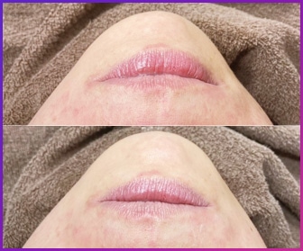 フェイス施術例01