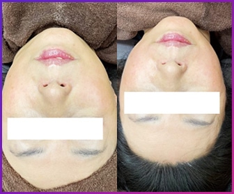 フェイス施術例02